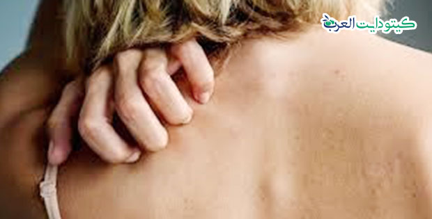 حساسية الكيتو - الطفح الكيتوني - الكيتو راش